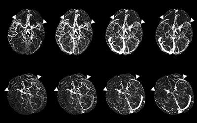 Delayed filling of the superficial middle cerebral vein in acute large artery occlusion